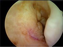 Vertical and anterior graft