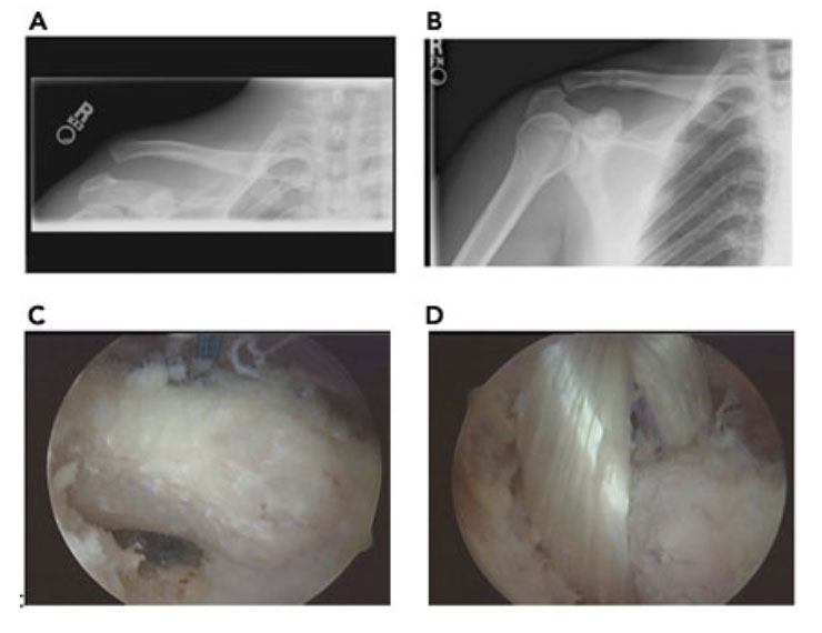 Can AC Joint Separation be Treated Without Surgery?