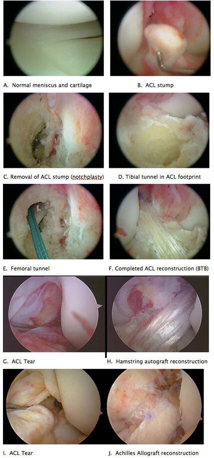 Arthroscopic pictures of an ACL reconstruction