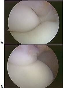 Elbow Arthroscopy