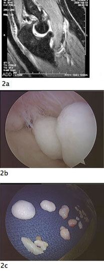 elbow arthroscopy fig2