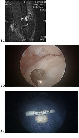 elbow arthroscopy fig3