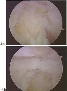 elbow arthroscopy fig4