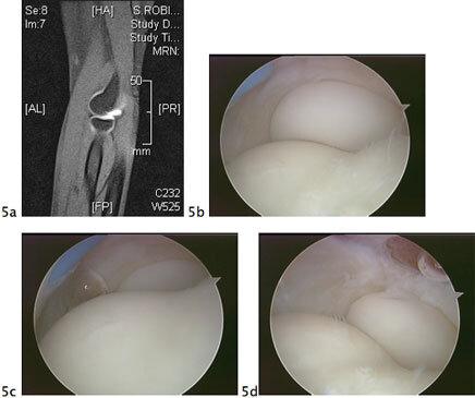 elbow arthroscopy fig5