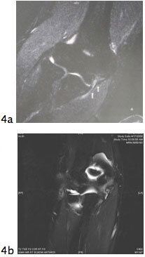 elbow ulnar fig4