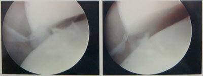elbow ulnar fig5