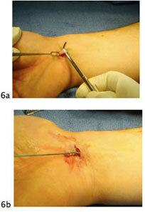 elbow ulnar fig6