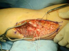 elbow ulnar fig7