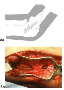 elbow ulnar fig8