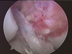 acl tear fig7