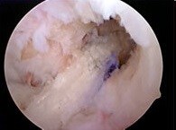 Revised with Achilles Allograft