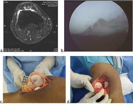 Osteochondral Autograft Transfer