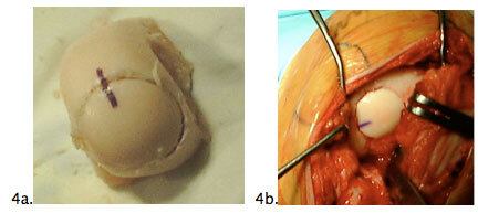 knee articular fig4