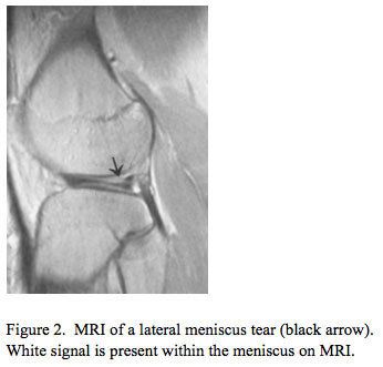 MRI of Lateral meniscus