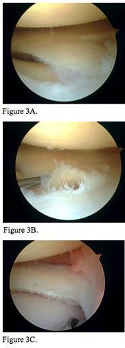 meniscus fig3
