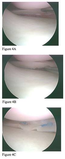 meniscus fig4