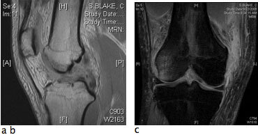 Multi-ligament Knee Injury