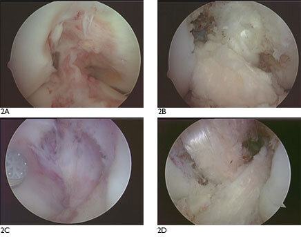 Multiligament Knee Reconstruction 2