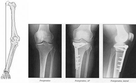 Knee Osteotomy