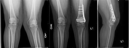 Knee Osteotomy fig1