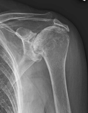 Shoulder