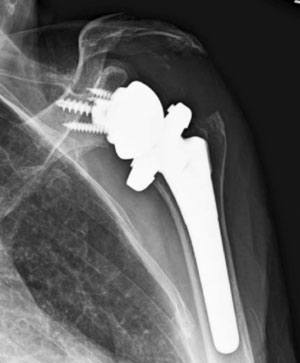 Shoulder