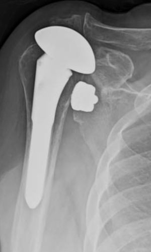 Shoulder