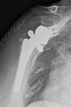 Shoulder