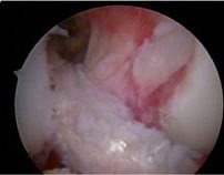 Revised with Achilles Allograft