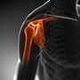Revision Shoulder Replacement