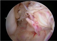 Vertical and anterior graft