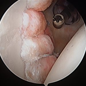 Arthroscopic Anterior Labrum Repair and Shoulder Stabilization