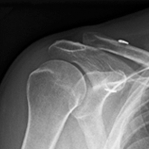 Shoulder2