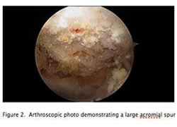 AC Joint Arthritis Distal Clavicle Resection