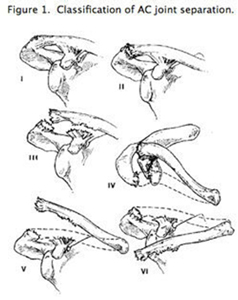 AC Joint Separation AC Joint Reconstruction