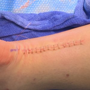 Achilles Tendon Repair