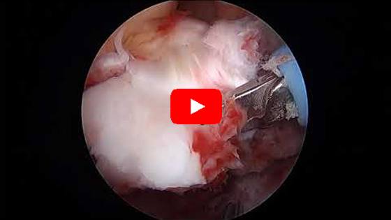 Arthroscopic ORIF Tibial Eminence Fracture