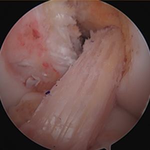 ACL Reconstruction