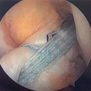 ACL Repair