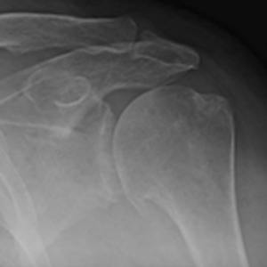 Anatomic Shoulder Replacement