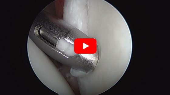 Anterior Stabilization and Labrum Repair with Concomitant SLAP repair