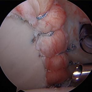 Arthroscopic Posterior Labrum Repair and Shoulder Stabilization