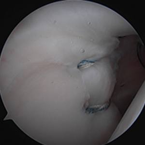 Arthroscopic Superior Labrum Repair (SLAP Repair)