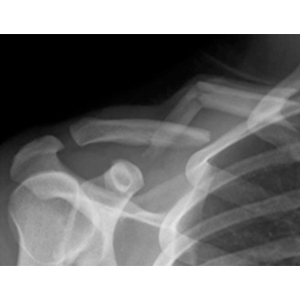 Clavicle Fracture (ORIF)