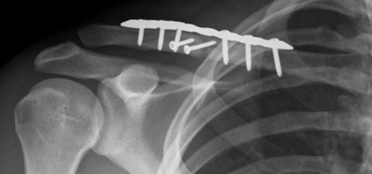 Clavicle Fracture (ORIF)