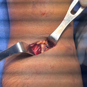 Distal Biceps Repair