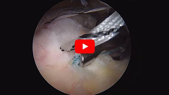 Exactech Anatomic Total Shoulder Replacement Using Preserve Stem and Cage Polyethylene Glenoid