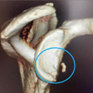 Latarjet or DTA Shoulder Bone Loss Surgery