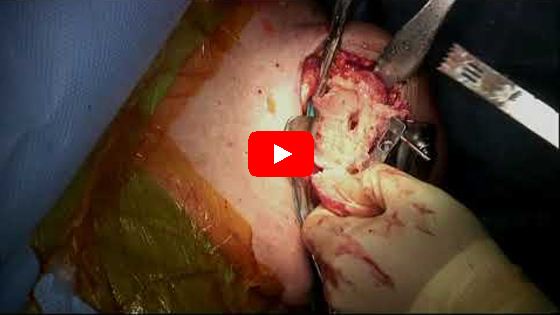 Exactech Anatomic Total Shoulder Replacement Using Preserve Stem and Cage Polyethylene Glenoid