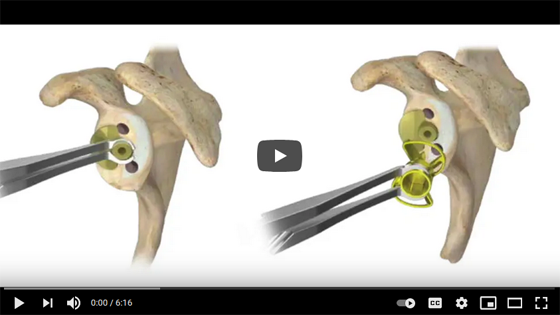 Anatomic Total Shoulder Arthroplasty with the NEW Alliance Glenoid System from Zimmer Biomet
